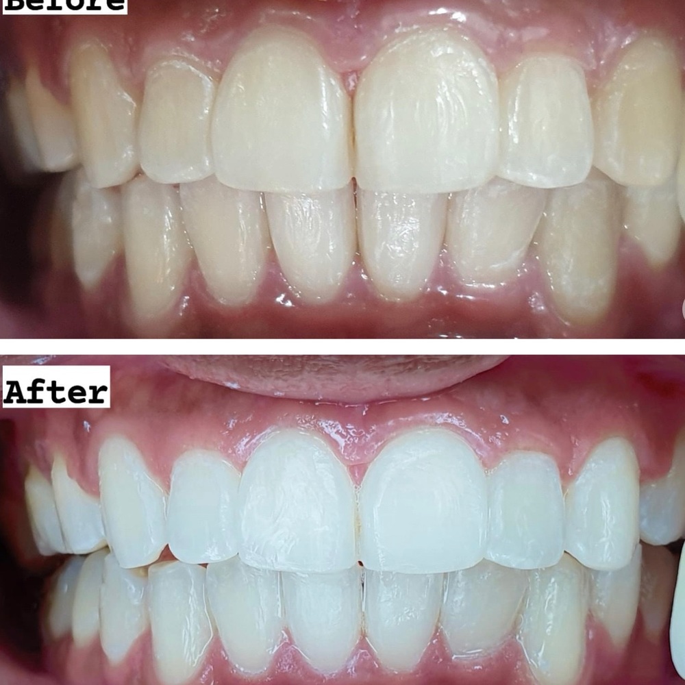 Professional Teeth Whitening Kit